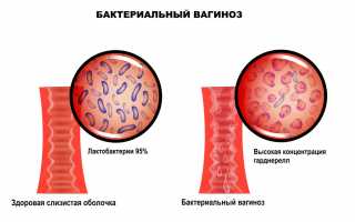 Вагиноз