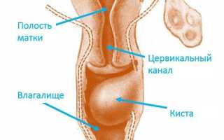 Лечение кисты влагалища народными средствами