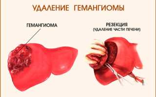 Причины и лечение гемангиомы печени