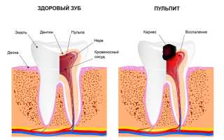 Пульпит: симптомы и лечение