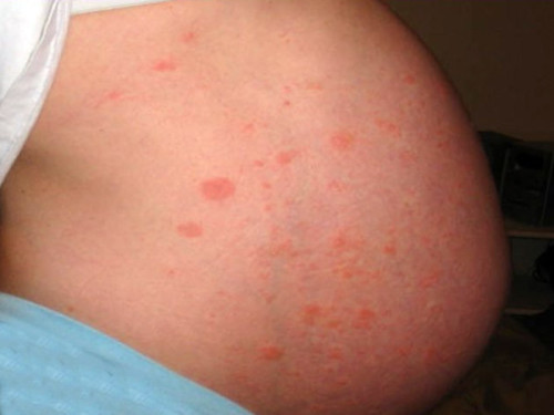 Polimorfnyj-dermatit-pri-beremennosti-500x375