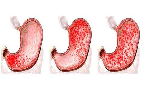 gastroduodenit-lechenie-narodnymi-sredstvami